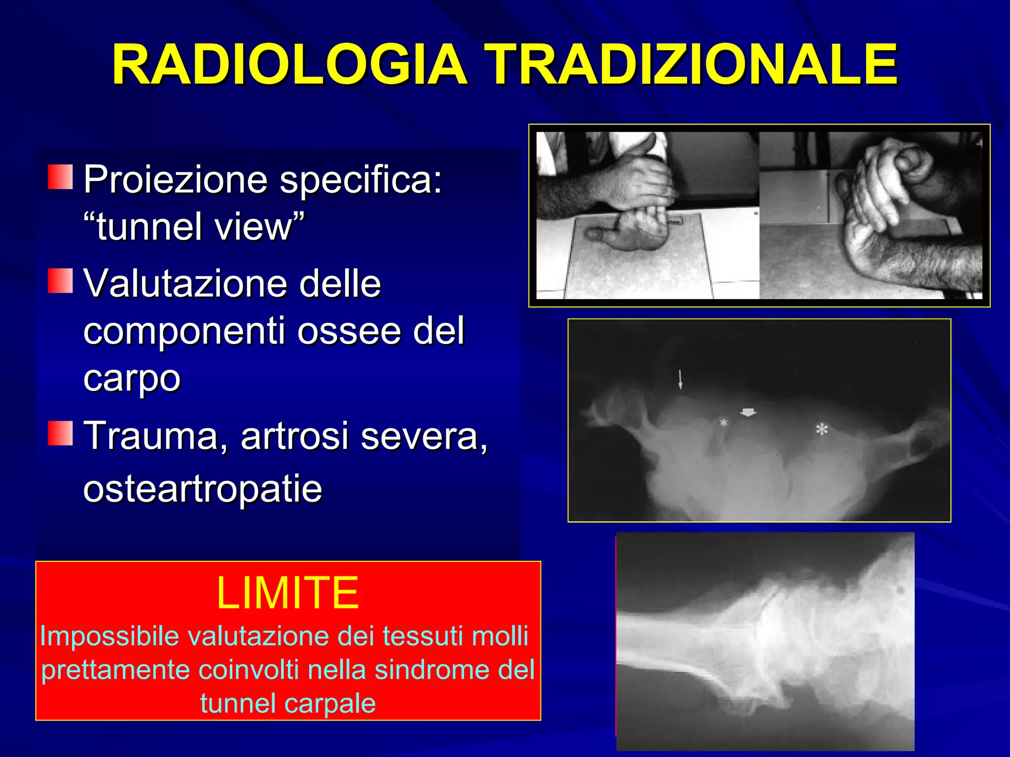 Vive Stecca per pollice e polso per mano destra o sinistra - Spica per tunnel carpale, tendinite e artrite nelle mani o nelle dita - Supporto di compressione per uomo e donna