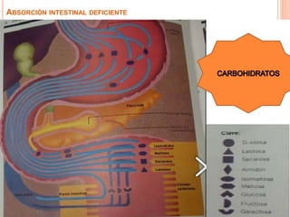 ABSORCIÓN INTESTINAL DEFICIENTE
 