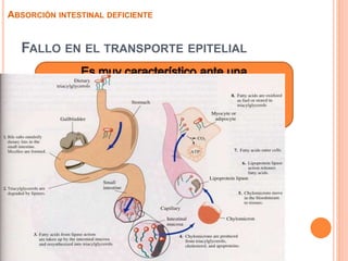 FALLO EN EL TRANSPORTE EPITELIAL
ABSORCIÓN INTESTINAL DEFICIENTE
 