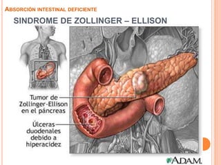 SINDROME DE ZOLLINGER – ELLISON
 Causado por tumores que usualmente están
localizados en la cabeza del páncreas además de
intestino delgado superior.
 Estos generan sobreproducción de la hormona
gastrina y se denominan gastrinomas.
 Los altos niveles de gastrina ocasionan
sobreproducción de ácido estomacal provocando
úlceras múltiples en estómago e intestino delgado
ABSORCIÓN INTESTINAL DEFICIENTE
 