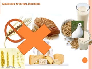 ABSORCIÓN INTESTINAL DEFICIENTE
 