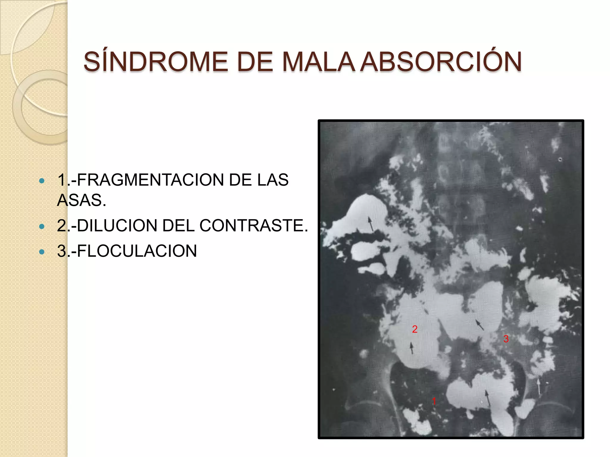 Sindrome de malabsorcion | PPTX
