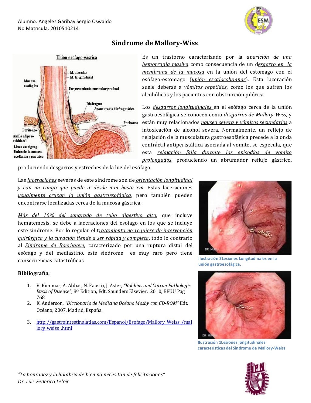 Sindrome de Mallory Weiss
