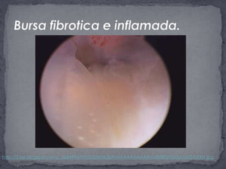 Bursa fibrotica e inflamada.http://3.bp.blogspot.com/_JgiBXPNvNYI/SDDxrMaIoFI/AAAAAAAAAIA/sz82lBQYSSQ/s1600-h/001.jpg