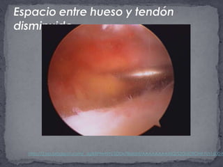 Espacio entre hueso y tendón disminuido.http://2.bp.blogspot.com/_JgiBXPNvNYI/SDDx78aIoHI/AAAAAAAAAIQ/SZGdD9OHKYI/s1600-h/005.jpg