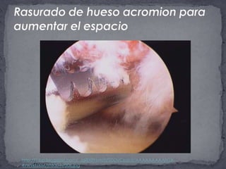 Rasurado de hueso acromion para aumentar el espaciohttp://1.bp.blogspot.com/_JgiBXPNvNYI/SDDyCsaIoII/AAAAAAAAAIY/A-4vwvkfJXM/s1600-h/006.jpg