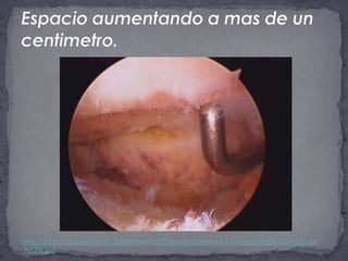 Espacioaumentando a mas de un centimetro.http://3.bp.blogspot.com/_JgiBXPNvNYI/SDDyIMaIoJI/AAAAAAAAAIg/CHqQkrjCxYo/s1600-h/008.jpg