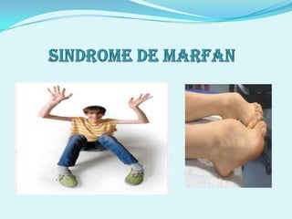 Sindrome de marfan exposicion