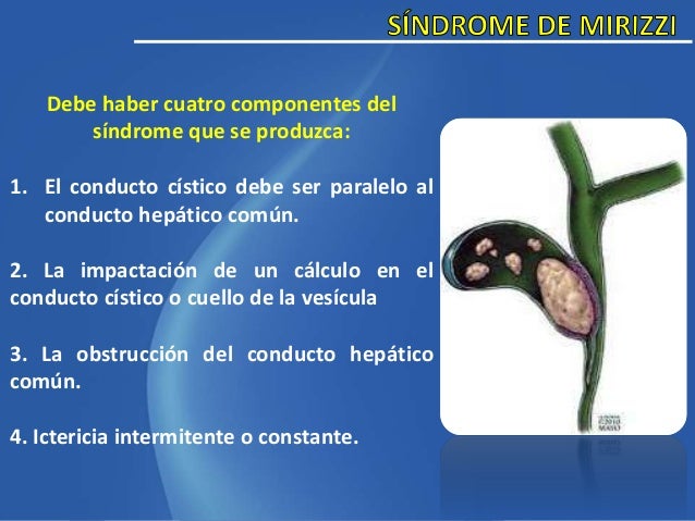 Sindrome de mirizzi