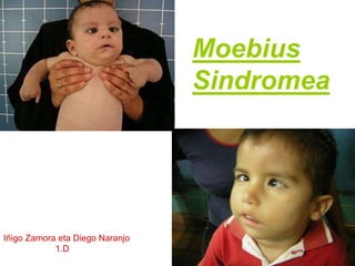 Moebius
Sindromea
Iñigo Zamora eta Diego Naranjo
1.D
 