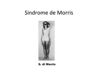 Sindrome de Morris
 