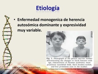Etiología
• Enfermedad monogenica de herencia
autosómica dominante y expresividad
muy variable.
Unidad de Genética Médica. Servicio de Pediatría.
Hospital Universitario Virgen de la Arrixaca, Murcia. Asociación Española de Pediatría. Ballesta Martinez MJ, Guillen-Navarro
E. Sindrome de Noonan. Protoc diagn ter pediatr. 2010;1:56-63.
 