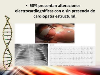 • 58% presentan alteraciones
electrocardiográficas con o sin presencia de
cardiopatia estructural.
 
