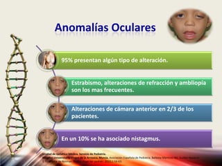 Anomalías Oculares
95% presentan algún tipo de alteración.
Estrabismo, alteraciones de refracción y ambliopía
son los mas frecuentes.
Alteraciones de cámara anterior en 2/3 de los
pacientes.
En un 10% se ha asociado nistagmus.
Unidad de Genética Médica. Servicio de Pediatría.
Hospital Universitario Virgen de la Arrixaca, Murcia. Asociación Española de Pediatría. Ballesta Martinez MJ, Guillen-Navarro
E. Sindrome de Noonan. Protoc diagn ter pediatr. 2010;1:56-63.
 