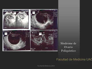 Síndrome de
Ovario
Poliquístico
Facultad de Medicina UAC
Facultad de Medicina UACH
 
