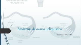 Síndrome de ovario poliquístico
IRM Diana Villegas M.
 