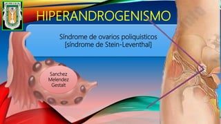 HIPERANDROGENISMO
Síndrome de ovarios poliquisticos
[síndrome de Stein-Leventhal]
Sanchez
Melendez
Gestalt
 