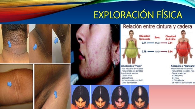 Resultado de imagen para signos y sintomas de ovarios poliquisticos