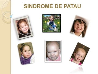 SINDROME DE PATAU 