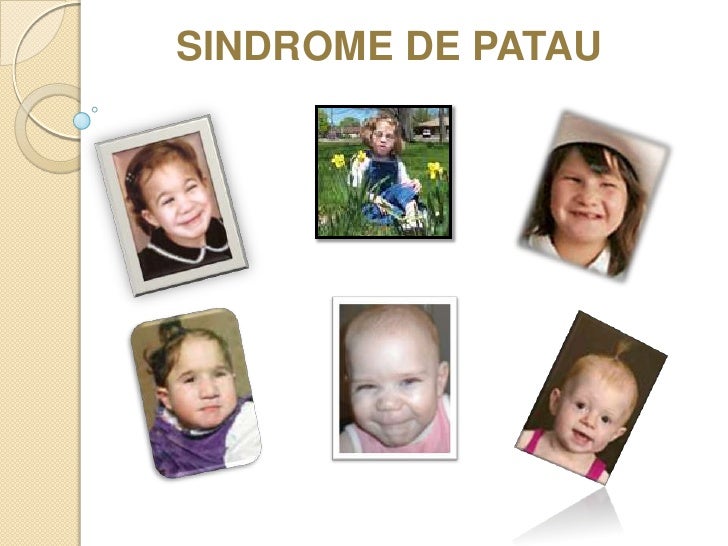 Sindrome de patau