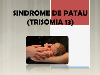 SINDROME DE PATAU 
(TRISOMIA 13) 
 