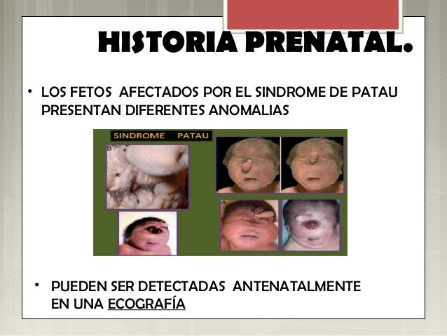 Sindrome de patau