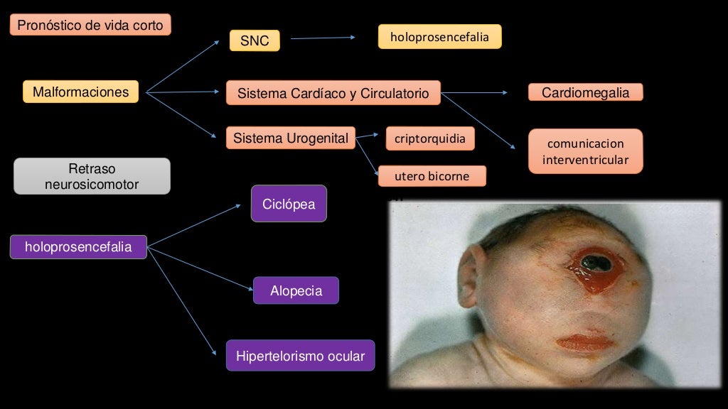 Sindrome de Patau