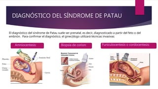 DIAGNÓSTICO DEL SÍNDROME DE PATAU
El diagnóstico del síndrome de Patau suele ser prenatal, es decir, diagnosticado a partir del feto o del
embrión. Para confirmar el diagnóstico, el ginecólogo utilizará técnicas invasivas:
Amniocentesis: Biopsia de corion: Funiculocentesis o cordocentesis:
 