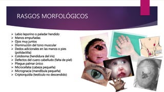 RASGOS MORFOLÓGICOS
 Labio leporino o paladar hendido
 Manos empuñadas
 Ojos muy juntos
 Disminución del tono muscular
 Dedos adicionales en las manos o pies
(polidactilia)
 Coloboma (hendidura del iris)
 Defectos del cuero cabelludo (falta de piel)
 Pliegue palmar único
 Microcefalia (cabeza pequeña)
 Micrognacia (mandíbula pequeña)
 Criptorquidia (testículo no descendido)
 
