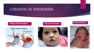 CUIDADOS DE ENFERMERÍA
Reflujo Gastroesofágico Fisuras Oro faciales
Posicionamiento
 