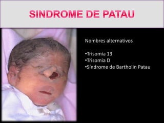 Nombres alternativos

•Trisomia 13
•Trisomia D
•Síndrome de Bartholin Patau
 