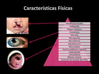 Características Físicas

                     Hendiduras faciales
                          Polidactilia
                      Pliegue simiesco
                          Colobomas
                           Microtia
                         Micrognatia
                        Microftalmia
                        Hipotelorismo
                         Microcefalia
                  Hernia umbilical e inguinal
                        criptorquidia
                         convulsiones
                       Retraso mental
                 Aumento de tamaño del riñón
 
