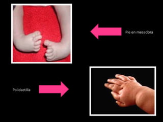 Pie en mecedora




Polidactilia
 