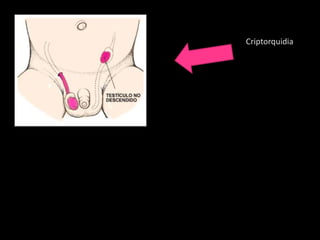 Criptorquidia
 