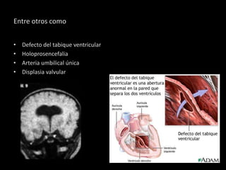 Entre otros como


•   Defecto del tabique ventricular
•   Holoprosencefalia
•   Arteria umbilical única
•   Displasia valvular
 