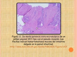 Figura 12. De media potencia vista microscópica de un pólipo yeyunal SPJ-tipo con el pseudo-invasión. Las flechas indican hamartomatosos mucosa del intestino delgado en la pared intestinal. http://www.ncbi.nlm.nih.gov/books/NBK1826/figure/ch1famcan.F12/?report=objectonly 