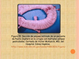 Figura 15. Sección de yeyuno retirado de un paciente de Peutz-Jeghers en la cirugía con múltiples pólipos pediculados. Cortesía de Victor McKusick, MD, del Hospital Johns Hopkins.  http://www.ncbi.nlm.nih.gov/books/NBK1826/figure/ch1famcan.F15/?report=objectonly 