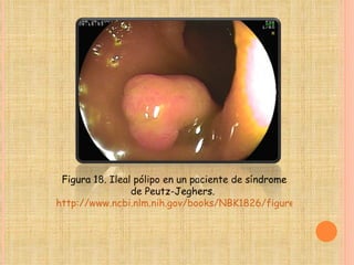 Figura 18. Ileal pólipo en un paciente de síndrome de Peutz-Jeghers.  http://www.ncbi.nlm.nih.gov/books/NBK1826/figure/ch1famcan.F18/?report=objectonly 