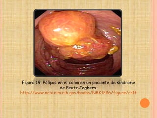 Figura 19. Pólipos en el colon en un paciente de síndrome de Peutz-Jeghers. http://www.ncbi.nlm.nih.gov/books/NBK1826/figure/ch1famcan.F19/?report=objectonly 