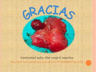 Intraluminal polyp after surgical resection. http://www.ncbi.nlm.nih.gov/pmc/articles/PMC2988858/figure/F2/ GRACIAS 
