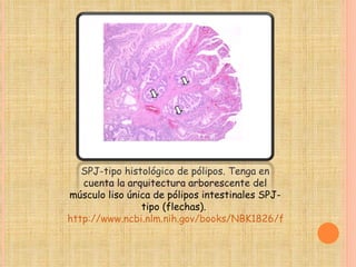SPJ-tipo histológico de pólipos. Tenga en cuenta la arquitectura arborescente del músculo liso única de pólipos intestinales SPJ-tipo (flechas).  http://www.ncbi.nlm.nih.gov/books/NBK1826/figure/ch1famcan.F9/?report=objectonly 
