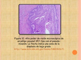 Figura 10. Alto poder de visión microscópica de un pólipo yeyunal SPJ-tipo con el pseudo-invasión. La flecha indica una zona de la displasia de bajo grado. http://www.ncbi.nlm.nih.gov/books/NBK1826/figure/ch1famcan.F10/?report=objectonly 