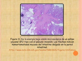 Figura 11. De la energía baja visión microscópica de un pólipo yeyunal SPJ-tipo con el pseudo-invasión. Las flechas indican hamartomatosos mucosa del intestino delgado en la pared intestinal. http://www.ncbi.nlm.nih.gov/books/NBK1826/figure/ch1famcan.F11/?report=objectonly 