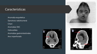Características
 Anomalia esqueletica
 Sianotosis radiohumeral
 Chiari
 Anomalias SNC
 Hidrocefalia
 Anomalias gastrointestinales
 Ano imperforado
 