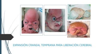 EXPANSIÓN CRANEAL TEMPRANA PARA LIBERACIÓN CEREBRAL
 