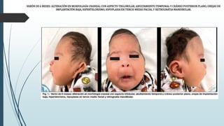 VARÓN DE 6 MESES: ALTERACIÓN EN MORFOLOGÍA CRANEAL CON ASPECTO TRILOBULAR, ABULTAMIENTO TEMPORAL Y CRÁNEO POSTERIOR PLANO, OREJAS DE
IMPLANTACIÓN BAJA, HIPERTELORISMO, HIPOPLASIA EN TERCIO MEDIO FACIAL Y RETROGNATIA MANDIBULAR.
 