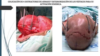 COLOCACIÓN DE 4 DISTRACTORES DE ARNAUD Y EXTERIORIZACIÓN DE LOS VÁSTAGOS PARA SU
ACTIVACIÓN DINÁMICA.
 