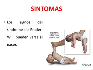 SINTOMAS
• Los signos del
síndrome de Prader-
Willi pueden verse al
nacer.
 