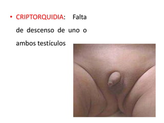 • CRIPTORQUIDIA: Falta
de descenso de uno o
ambos testículos
 