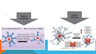 -
Edema
vasogénico
Edema
Citotóxico
 